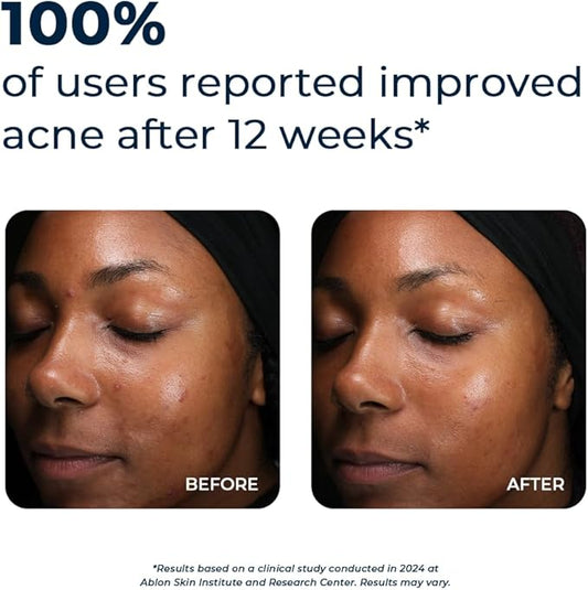 VitaMedica Clear Skin Vitamin Formula | Acne Supplement for Skin Clearing | Breakout Treatment for Women and Men | Vitamins A, C, E, Selenium, Chromium, and Zinc for Acne and Skin Health | 2 Pack
