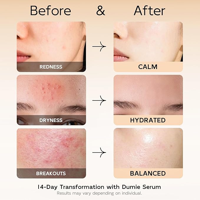 10% Azelaic Acid Redness Soothing Serum, Hyaluronic Acid & Centella Asiatica, Facial Serum for Sensitive Skin Relief, Korean Skincare Barrier Repair & Hydration - 30ml/1.01 fl oz