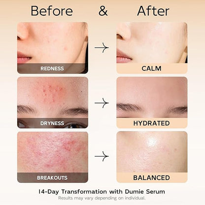 10% Azelaic Acid Redness Soothing Serum, Hyaluronic Acid & Centella Asiatica, Facial Serum for Sensitive Skin Relief, Korean Skincare Barrier Repair & Hydration - 30ml/1.01 fl oz